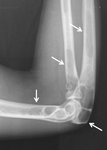 X-ray of the right elbow showing multiple bone cysts in radius, ulna and humerus (arrows).